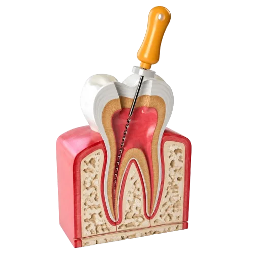 Root canal cross-section showing a dental file in the pulp canal